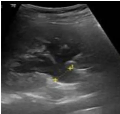 Figure 1: Renal and urinary tract ultrasound, coronal section. Grade II right hydronephrosis. Source: authors.