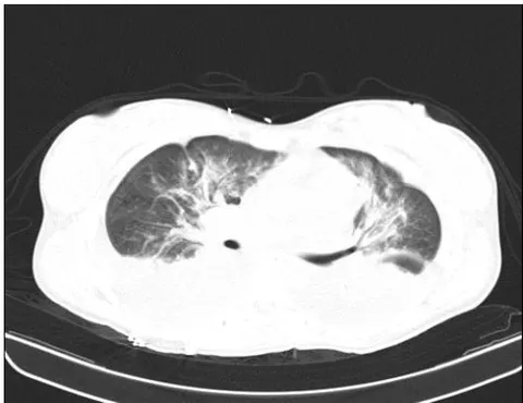 Figure 2: Chest tomography, coronal section. Bilateral pleural effusion. Source: authors. Figure 3: Chest tomography, axial slice. Bilateral pleural effusion. Source: authors.