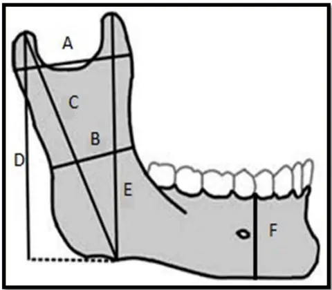 Fig. 1: Image showing measurement from the reference lines drawn from the anatomic landmarks of the mandible. (Diagram showing mandibular ramus measurements adapted from Saini et al. (17))