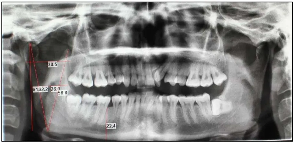 Fig. 2: OPG image showing measurements taken on the right side of the mandible.