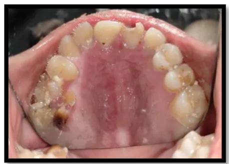 Figure 1: (a) Healing scars on face, (b&c) Foreshortening of distal phalanges of hand (d) Multiple burn scars on leg (a)