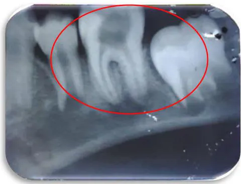 Figure 3: Radiolucency involving enamel, dentin and pulp, loss of lamina dura in mesial and distal root, diffused periapical radiolucency with mesial and distal root i.r.t 46
