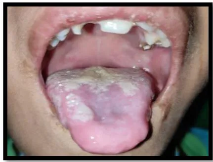 Figure 2: Intraoral examination (a&b) Multiple carious teeth, poor oral hygiene, (c&d) Diffused whitish mucosal lesions seen on the dorsal and ventral aspect of tongue, Labial soft tissue deformity of the patient due to biting