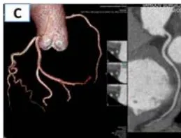 Figure 6: 53-year-old female patient. 3D - volumetric image of EAT with the determination of the total volume (A), axial projection with the designation of the boundaries of the epicardial fat depot (B), curvilinear reconstruction of the CA without areas of stenosis (C).