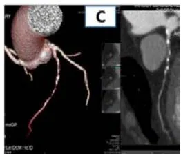 Figure 8: 65-year-old female patient. 3D-3D image of the EAT (A), axial projection with the designation of the EAT boundaries (B), curvilinear reconstruction of the CA with the presence of hemodynamically significant (HDS) areas of stenosis (C) (CAD-RADs 4).