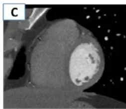 Figure 3: Determination of EAT thickness: maximum distance at the level with/3 RCA (A), at the level of the ventricular septum (B) and along the lateral wall of the right ventricle (C).