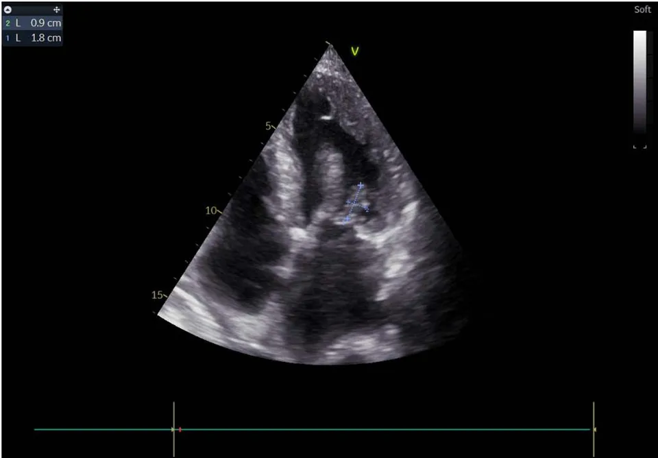 Figure 3: The mitral vegetation measuring 18*9mm