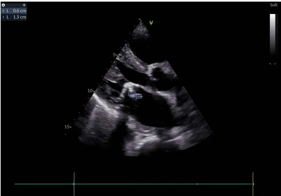 Figure 1: Moderate mitral regurgitation Figure 2: The mitral vegetation measuring 6*13mm
