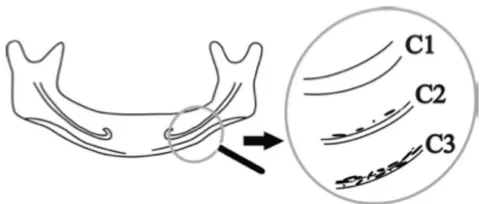Figure 1: Illustration of the Mandibular Cortical Index