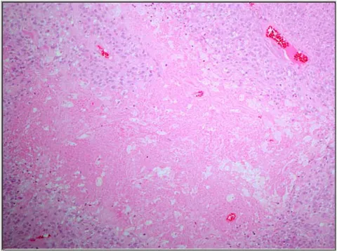 Figures Legends: Figure 1: Necrosis in a grade II meningioma. The surrounding viable meningioma tissue shows cellularity and lack of pattern. (H&E X200).