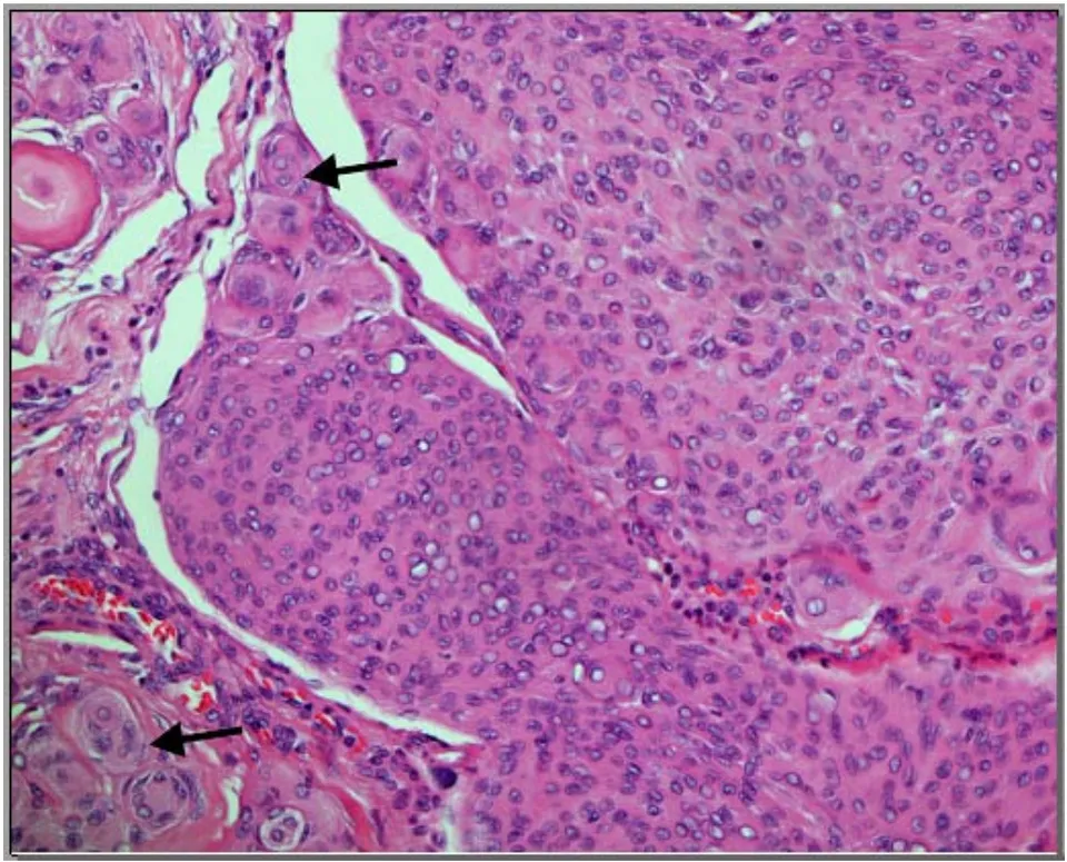 Figure 2: A meningioma showing cellular areas, foci of increased N: C ratio and partial lack of pattern. In the same field, meningothelial pattern with prominent whorls (arrows) is present (H&E X200).