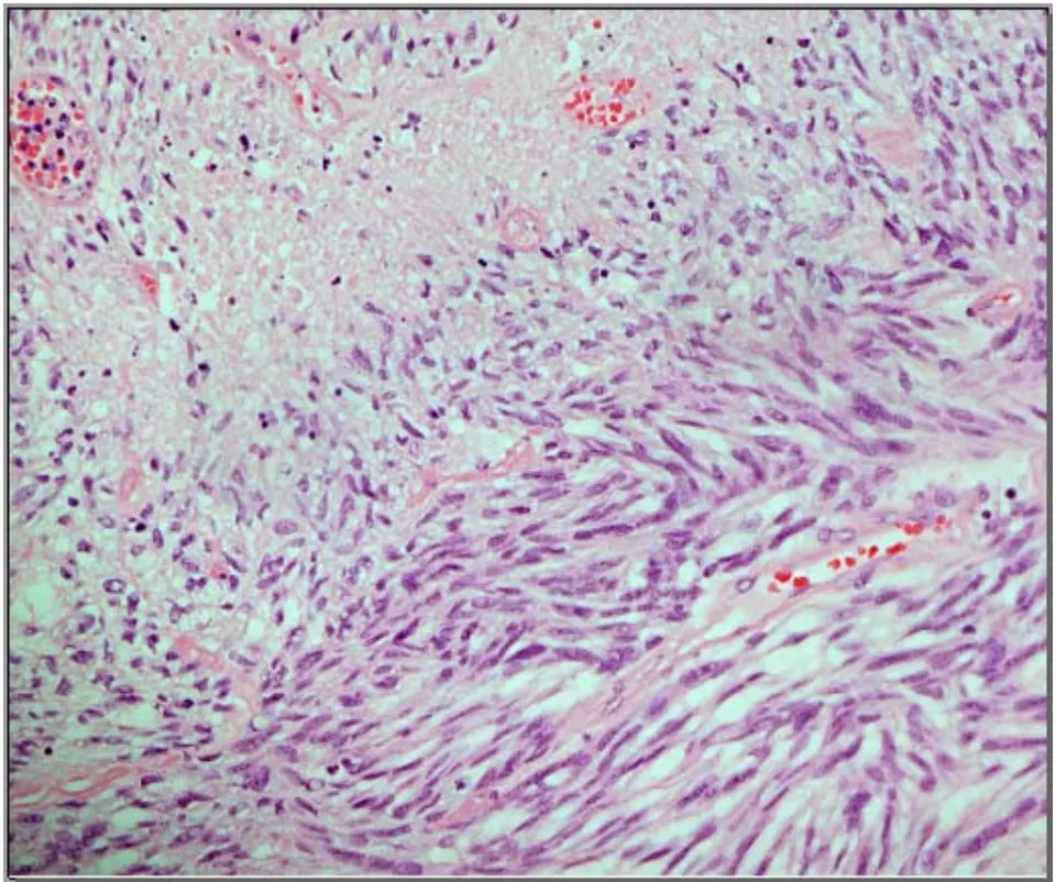 Figure 3: A meningioma showing focal necrosis and adjacent cellular proliferation of spindle cells with increased N: C ratio and foci of small cell change. Two pathologists considered such foci to be "sarcomatoid" (H&E, x200).
