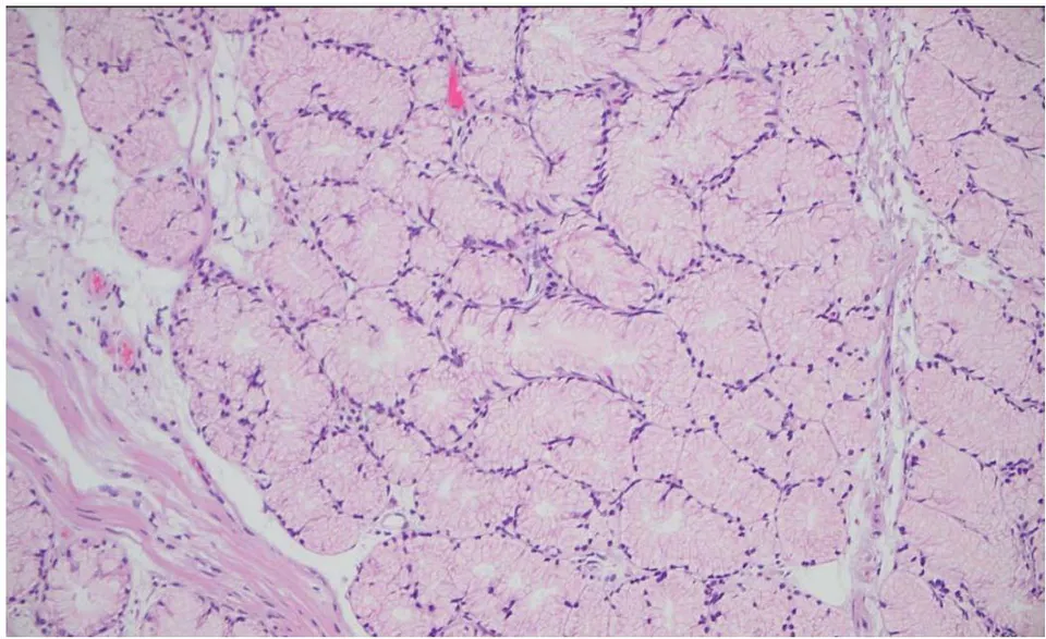 Figure 2: Photomicrograph of Brunner gland nodule (H & E x200)