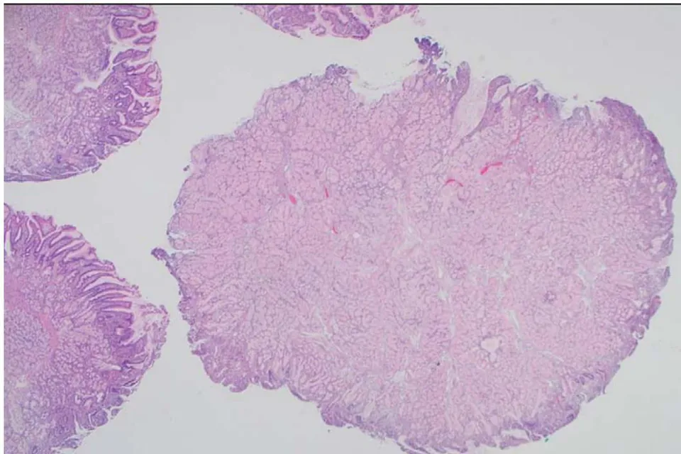 Figure 1: Photomicrograph of Brunner gland nodule (H & E x20)