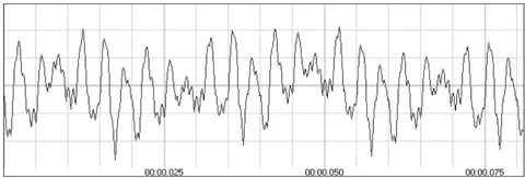 Fig. 3: An example of ASEp in a patient with clinical manifestations of cerebellar syndrome is presented. There is an increase in the amplitude of the PIII peak bilaterally with a relative expansion of the peak-to-peak interval PIII-PV