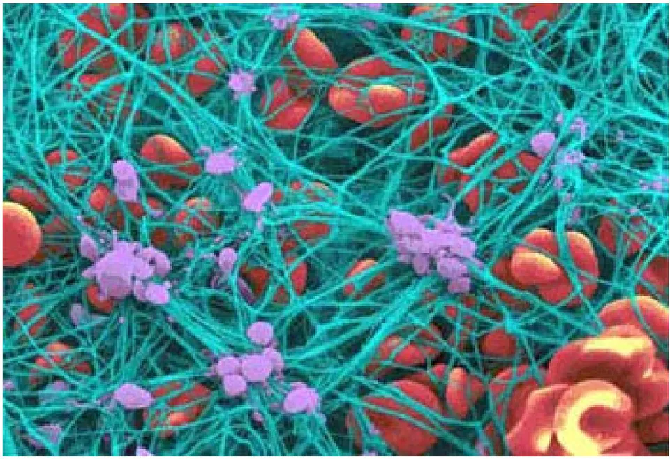 Figure 2: Phospholipids surface, platelet and endothelium, consist of extrinsic, intrinsic and common pathways results in formation of stable fibrin clot