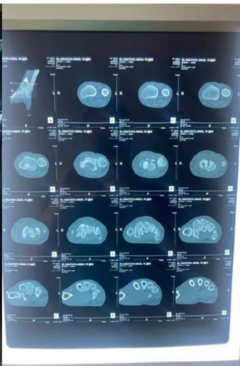 Figure 2: The computed tomography (CT) scan confirmed the scaphoid fracture and the localized and nonaggressive nature of the cyst.
