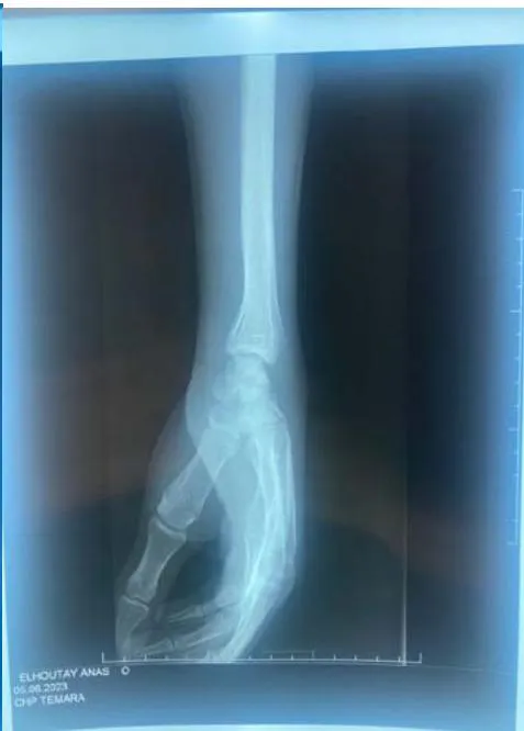 Figure 1: The standard X-ray of the wrist, in frontal and oblique views, revealed a displaced fracture of the scaphoid on a lacunar image located in the middle portion of the scaphoid.