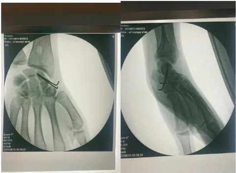 Figure 3: Postoperative radiograph after curettage, grafting, and stabilization with two pins.