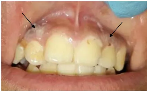 Figure 3: Oral lesions in a patient with T1DM. Xerostomia and pallor of the mucous membranes, coated tongue, flaky taste buds and the presence of 2 traumatic ulcers in the jugal mucosa are seen.