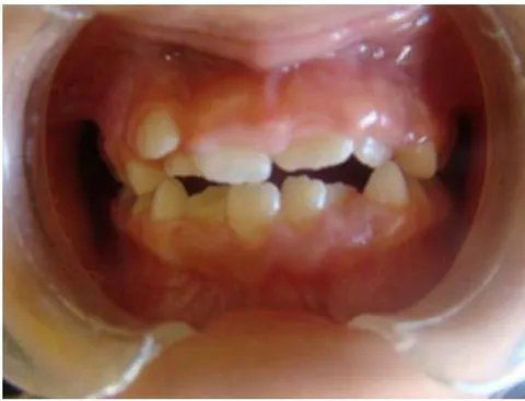 Figure 2: Gingivitis in a patient with T1DM. The erythematous and edematous gums, especially the upperone, are clear.