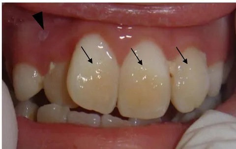 Figure 5: Soft tissue lesions in a patient with B-cell acute lymphoblastic leukemia (B-cell ALL). There is a well-delimited ulcerative HSV-like lesion of whitish coloration (arrowhead) in the swollen and erythematous gingival mucosa, and presence of dental-bacterial plaque (DBP) (arrows).