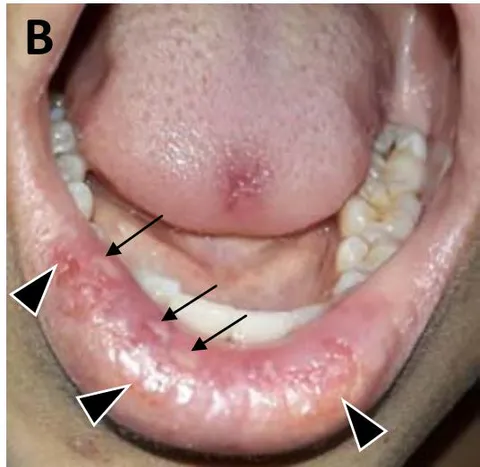 Figure 6: Oral lesions in a patient with B-cell acute lymphoblastic leukemia (B-cell ALL). In both photographs you can see different lesions: hypohydrosis and pallor of mucous membranes and multiple caries. (A) An ulcer in the palatine mucosa (arrow), secondary to mucositis; and exfoliative cheilitis (arrowheads). (B) On the back of the tongue there is an irregular ulcer with erythematous contour, secondary to mucositis; multiple HSV-like ulcers with an erythematous contour (arrows) distributed in the labial mucosa along with traumatic ulcers and exfoliative cheilitis, mainly on the external part pf the lower lip (arrowheads).