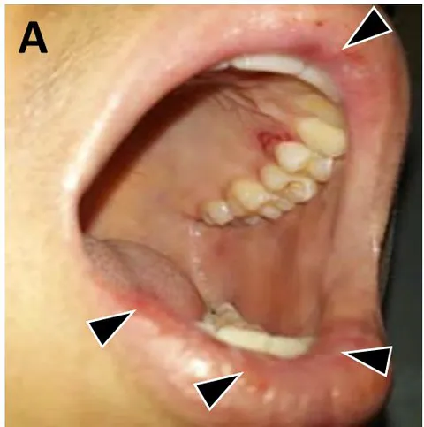 Figure 4: Candidiasis lesions in a patient with B-cell acute lymphoblastic leukemia (B-cell ALL). Pale mucous membranes are seen with the abundant presence of DBP on the tooth surfaces. Whitish lesions of fungal origin (Candida albicans); they are found in the gingival mucosa and the bottom of the sac of the upper arcade.