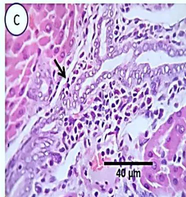 Fig. 4: Photo-micrograph from liver, group (4), showing, portal biliary proliferation (A, yellow arrow, B, black arrow), congestions of portal blood vessels(A, black arrow), round cell infiltration and interstitial lymphocytic and macrophages aggregations replacing previous necrotic patches (B, blue arrow). Scale bars 120, 40, 40 um.