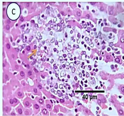 Fig. 5: Photo-micrograph from liver, group (3), showing, portal biliary proliferation (yellow arrow), congestions of portal blood vessels (black arrow) and round cell infiltration and interstitial lymphocytic and macro-phages aggregations replacing previous necrotic patches (orange arrow). Scale bars 120, 40, 40 um.