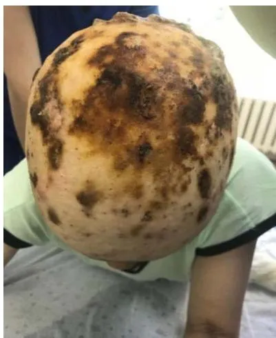 Fig. 2: The scalp at admission.