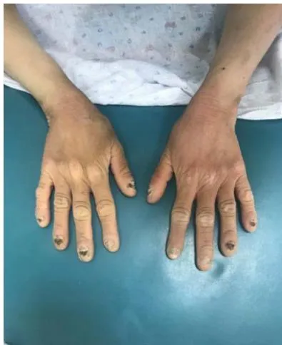 Fig. 3: Onychomycosis of the upper extremities.
