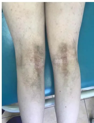 Fig. 1: Hyperkeratosis of the popliteal pits.