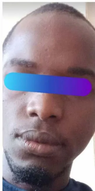 Figure 4: Before and After Surgical Excision of a Labial AVM