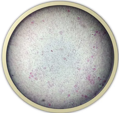Figure 5: Microscopically, thoracic ganglioneuroma have a structure formed of spindle cells with wavy nuclei, with no cellular pleomorphism and various degrees of myxoid degeneration.