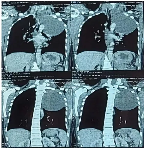 Figure 1: Chest X-ray revealed a large well defined homogenous radio-opacity in the left upper and part of the mid-zone silhouetting aortic notch. It is showing a negative Cervico-thoracic sign. Figure 3: Contrast enhanced Computed tomography Chest revealed a large well defined soft tissue density mass lesion is noted in the left upper lobe. Laterally extending upto left lateral and posterior chest wall, however no erosion of overlying ribs. No mediastinal invasion was seen.