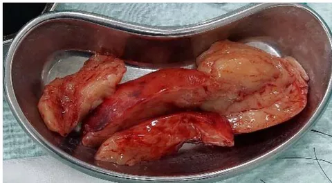 Figure 4: Piecemeal removal of left intrathoracic mass