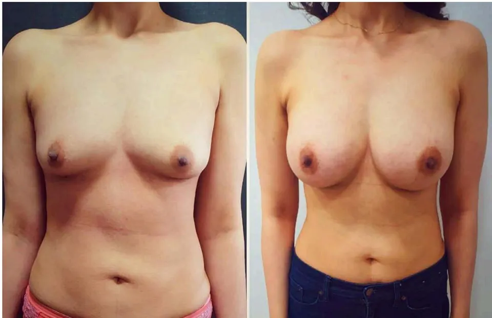 Fig. 8: Before and After of 33 Year Old, 6 Months after 305cc Smooth High Profile Implant in Sub Fascial Plane with 40 cc Fat Grafting One Ach Side
