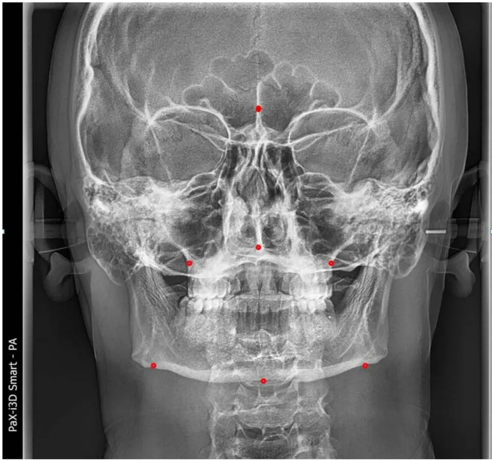 Figure 1: Points (Landmarks) used in Maxilla-Mandibular Relationship Indicators of the Frontal Cephalogram