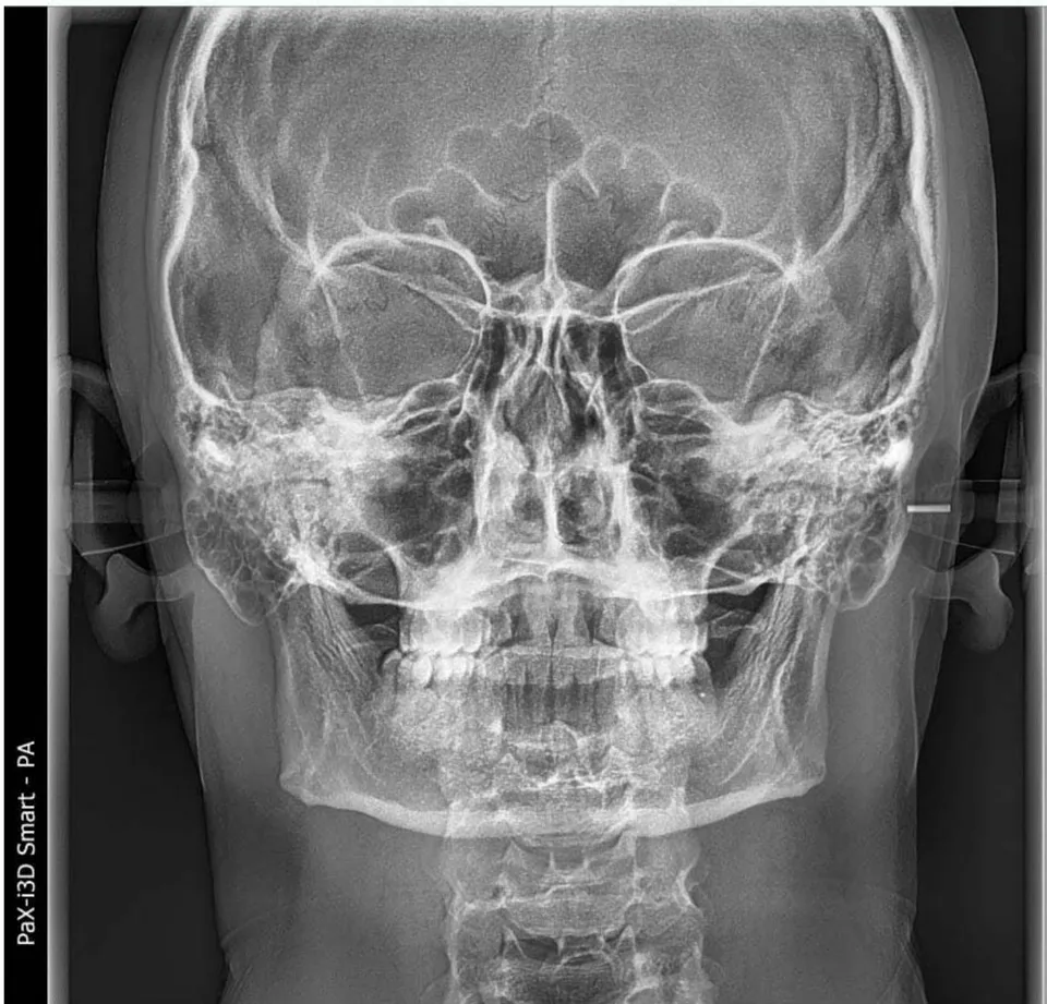 Figure 2: Comparison of upper and lower Jaws (Maxillo - Mandibular Comparison)