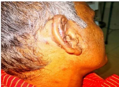 Figure -10: Perichondritis due to accident. Figure-11: Helical incision along the margin of the helix of pinna.