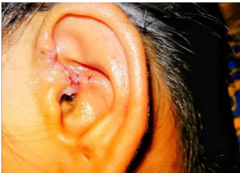 Figure -9: Auricular sinus with perichondritis.