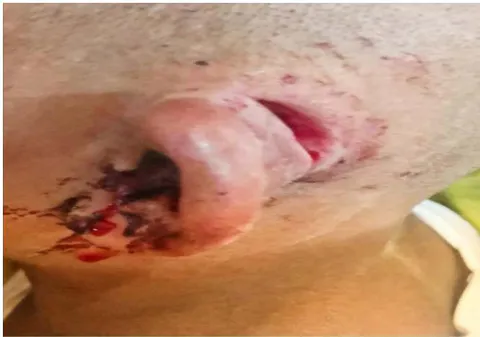 Figure -6: Cellulitis of pinna due to Furunculosis. Figure-7: Post infective perichondritis including pos-auricular abscess of 03 years child.