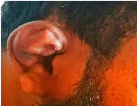 Figure -3: Auricular abscess due to blunt trauma. Figure-4: Close view of the figure-3 case.