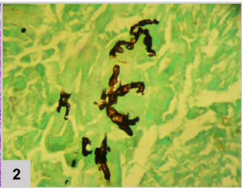 Figura 2: Lung biopsy (200x magnification). (1) Pulmonary tissue in hematoxylin and eosin showing granulomatous reaction with epithelioid histiocytes and multinucleated giant cells. (2) Pulmonary tissue in Grocott's stainrevealing fragments of broad, wavy and short hyphae, matching Zygomycosis by mucorales, longitudinal and cross-sectioned With the fungal lung infection diagnosis (zygomycosis), without previously response to Fluconazole, Amphotericin B was administered. The fever disappeared and there was no need for supplemental oxygen, the patient was discharged from the hospital with mild tachypnea.