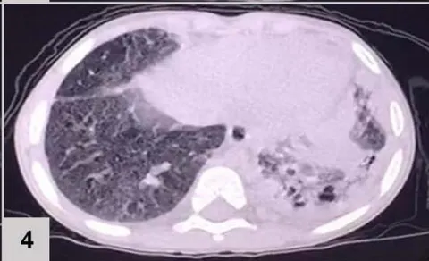 Figure 1: CT of the chest results: extensive consolidation, with air bronchograms and cystic images in between, in the left lung (3 and 4); ground-glass opacities, diffusion in the lower left lobe (1 and 2); nodular opacity, no sign of calcification in between, on both lungs (1, 2 and 3); reticular and linear opacity and parenchymal bands in the upper lobes (3 and 4); small pleural effusion on the left (1 and 2); adjacent subsegmental atelectasis (2 and 4)