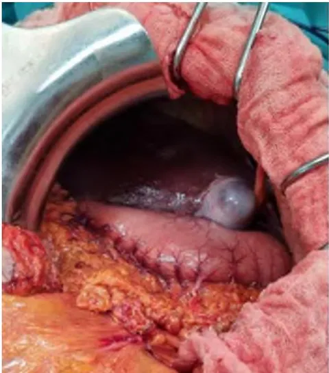Fig. 4: Intraoperative Images Showing the Stomach on the Right, the Liver and Gallbladder on the Left Confirming the Situs Inversus Abdominalis