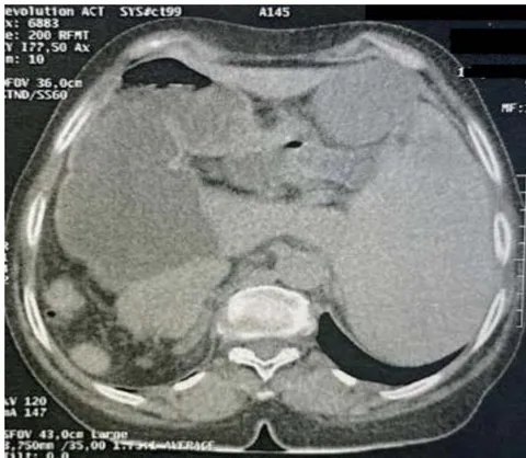 Fig. 1: Situs Inversus Abdominalis: Stomach on the Right, Liver and Gallbladder on the Left