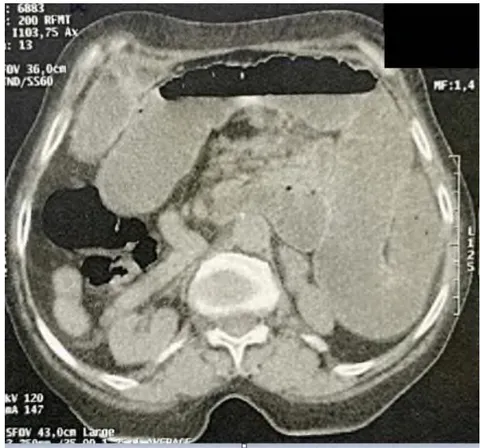 Fig. 2: Small Bowel Obstruction and Situs Inversus Abdominalis