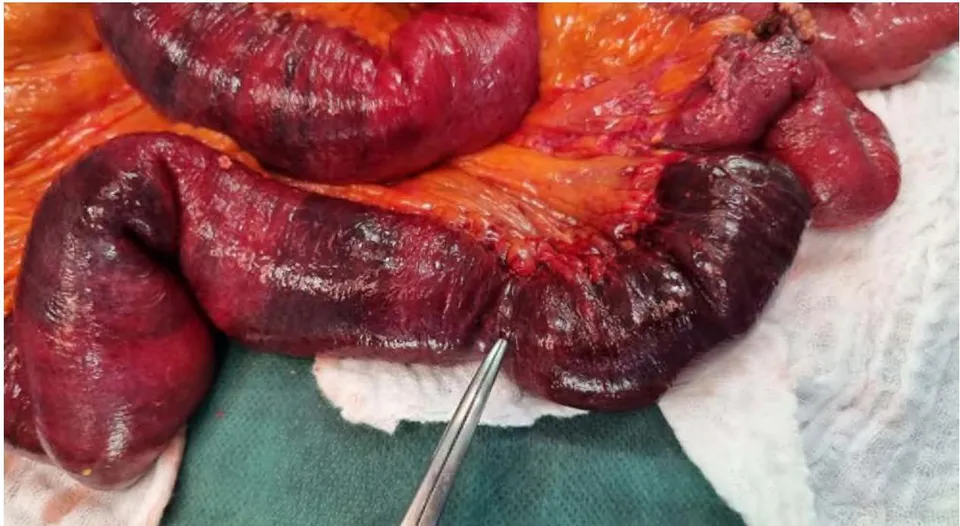 Fig. 3: Intraoperative Images Showing Bowel Necrosis